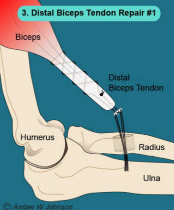 Figure 3: Distal Biceps Tendon Repair #1