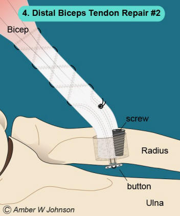 Figure 4: Distal Biceps Tendon Repair #2