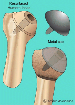 Figure 2: Resurfacing Arthroplasty