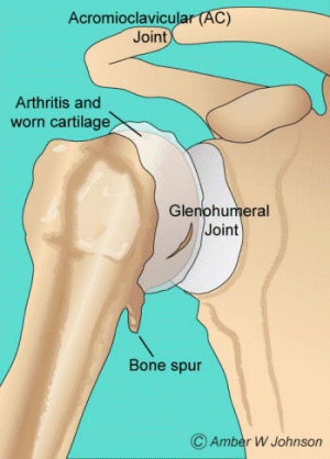 Figure 1: Arthritis