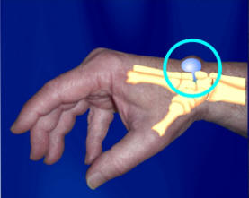 Figure 2: Ganglion Cyst Location