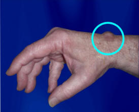 Figure 1: Ganglion Cyst on Wrist
