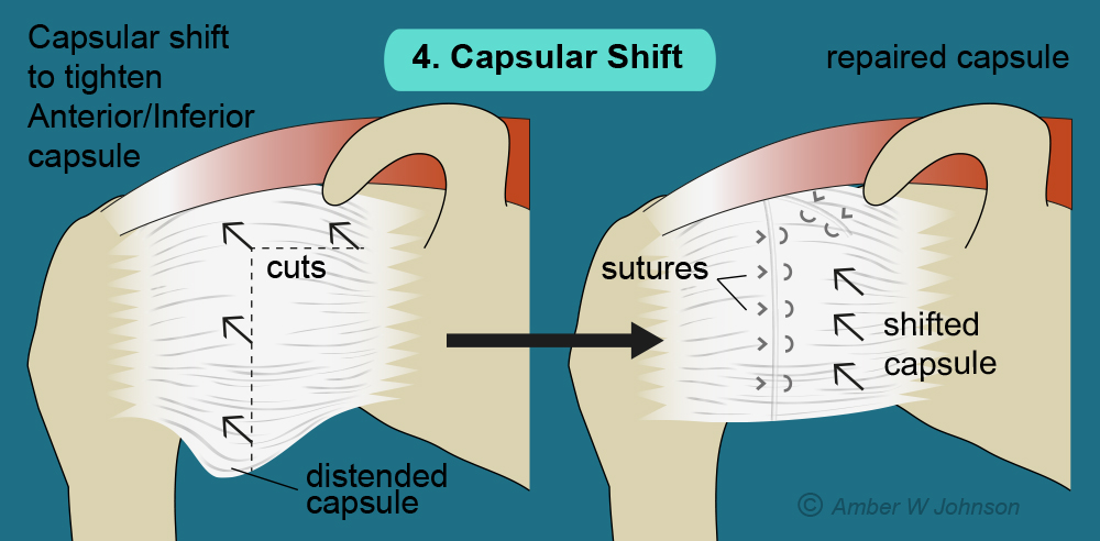 4. Capsular Shift final