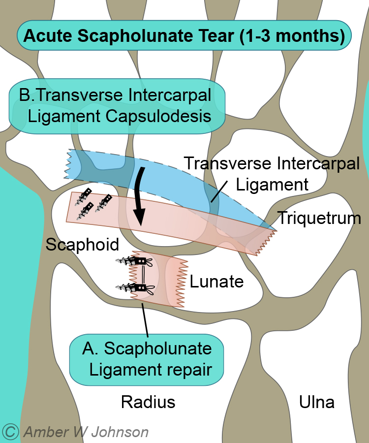 Scapholunate ligament injury - Melbourne Hand Surgery